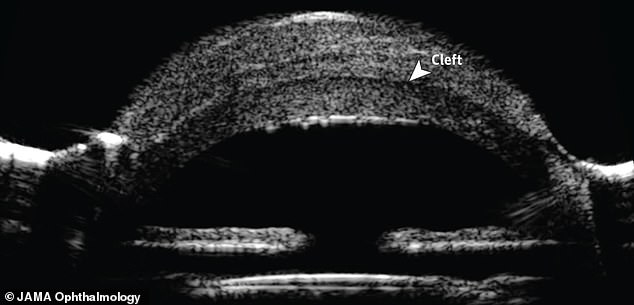 An ultrasound scan revealed he had a cleft (pictured) 1.5mm into his eye, between his cornea and the lesion. The doctors therefore had to be particularly careful when removing the mass