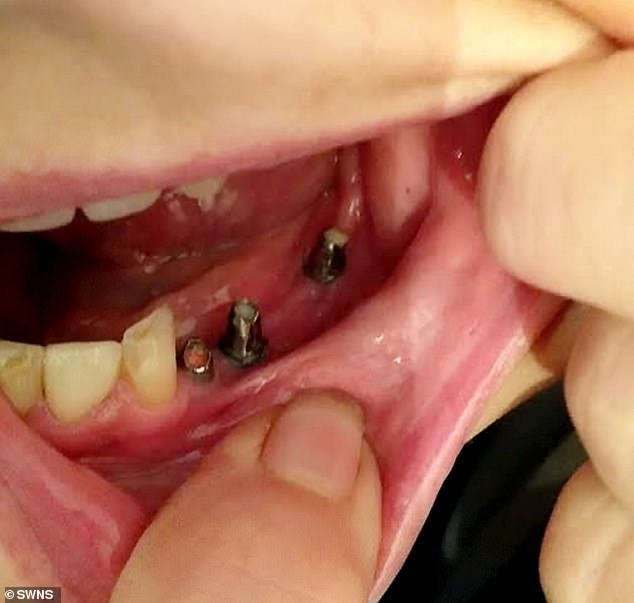 However, the work was so poor that one of her teeth fell out and her remaining implants had to be surgically removed from her gums