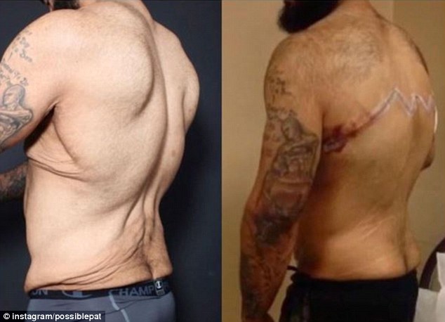 Brocco most recently got 30 pounds of excess skin removed, seen here in a before and after taken just days following his surgery 